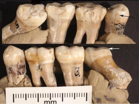 Первыми стоматологами были неандертальцы
